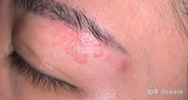 眼皮上起了这个东西是什么发红凸起且痒