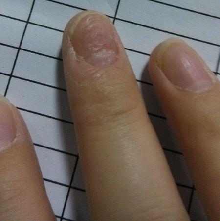 然后开始长坏,变成了一层一层的坑坑洼洼的指甲是怎么了?