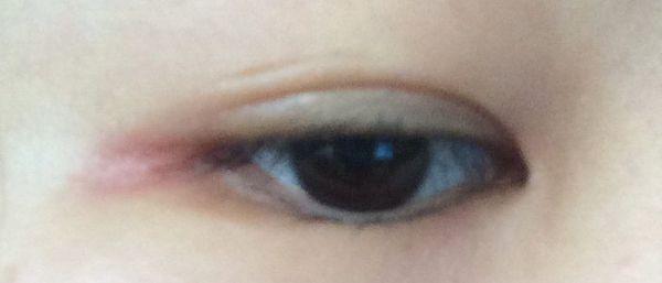 眼角痒,红.去医院看医生说是过敏,开了尤