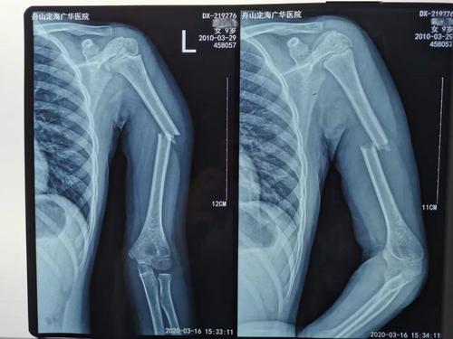 女童玩耍摔倒,手臂瞬间骨折变形!还好遇到了他们