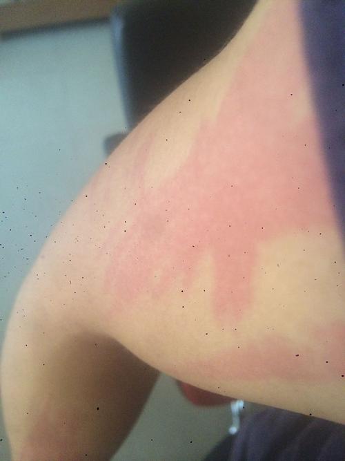 前几天皮肤过敏过,原因是穿一件刚买回来的新衣服,麻料的,现在疙瘩没