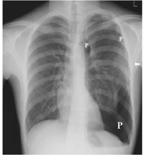 图文详解丨气胸的影像学表现