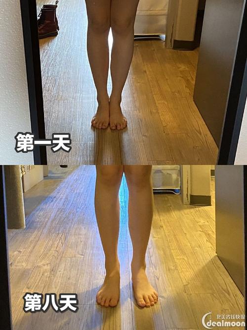 收到包裹后我便立马拍了当时小腿的照片,之后每天使用3号平面按摩头