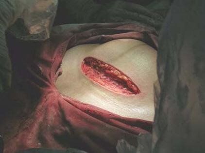 [转载]图解剖腹产全程