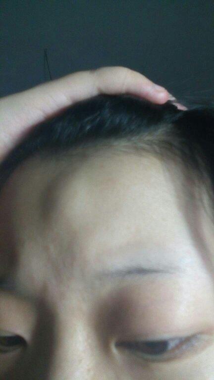 额头上有一个小包,不痛不痒,之前不小心撞了一下额头然后就出现了,听