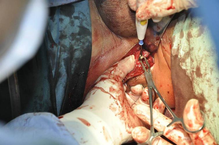 一天4个手术,最后一个病人直肠 肿瘤 ,距肛门5c