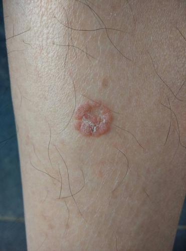 这是什么,是猴子,还是扁平疣,怎么治疗?