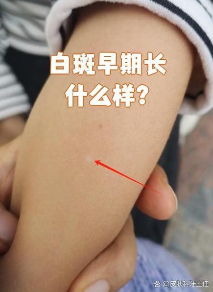 白斑刚开始出现时,皮肤上会冒出一些大小不一的白色斑点