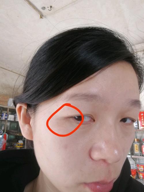 现在四个半月了,今天发现两边眼角开始长斑了,想问问要没有长斑的妈妈