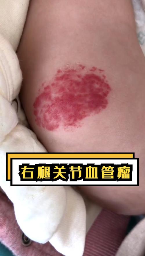右腿关节血管瘤_婴幼儿_婴幼儿血管瘤_母婴_育儿经验