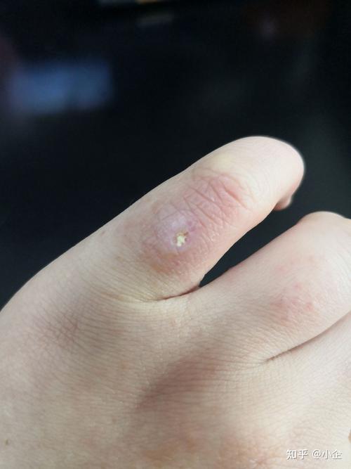 我这还是个黄豆般大的小水泡,用着这么长的时间才好转.