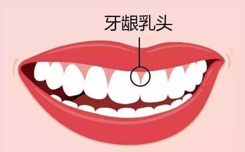 如果和牙齿不能紧贴在一起,出现了炎症,可能会出现牙龈乳头增生的情况