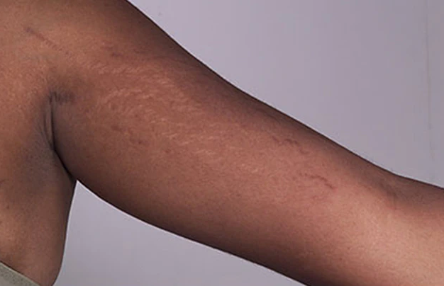 手臂上的膨胀纹,图片来源mayoclinic