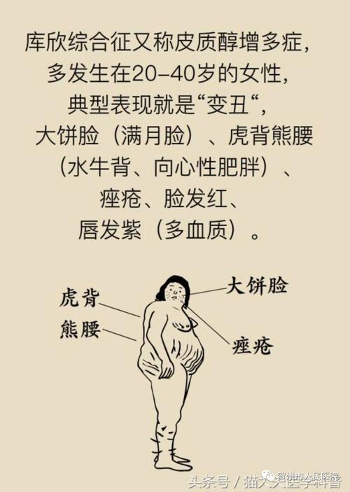 临床表现为身体向心性肥胖,满月脸,水牛背,多血质, 腹部大腿部皮肤有