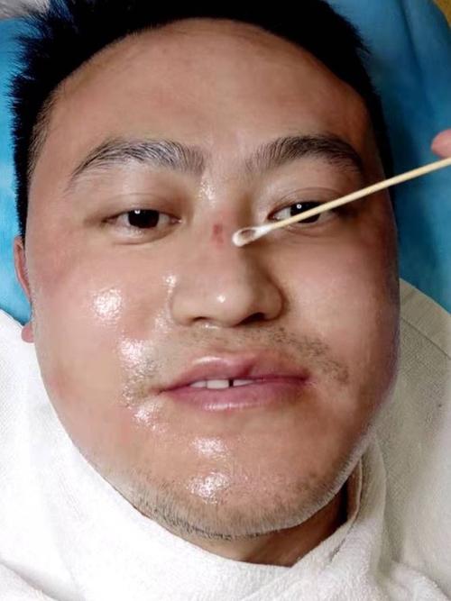 速愈美微针去深层真皮斑,即刻对比～92鼻子上有一块