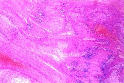 白色血栓的形态