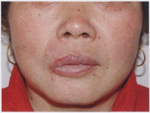 典型病例1:唇部交叉瓣修复右侧上唇鳞状细胞癌切除后全层缺损
