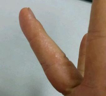 无名指上起水泡样湿疹图片