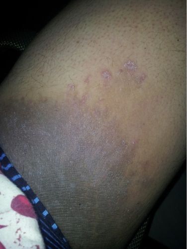 大腿内侧瘙痒 不知道是不是股癣