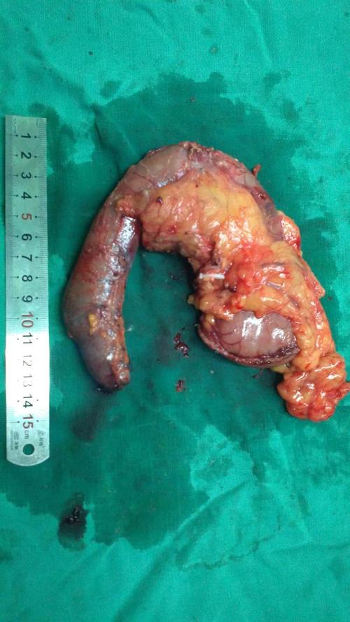 胰十二指肠切除术一例胃肠胸外科 梁万明
