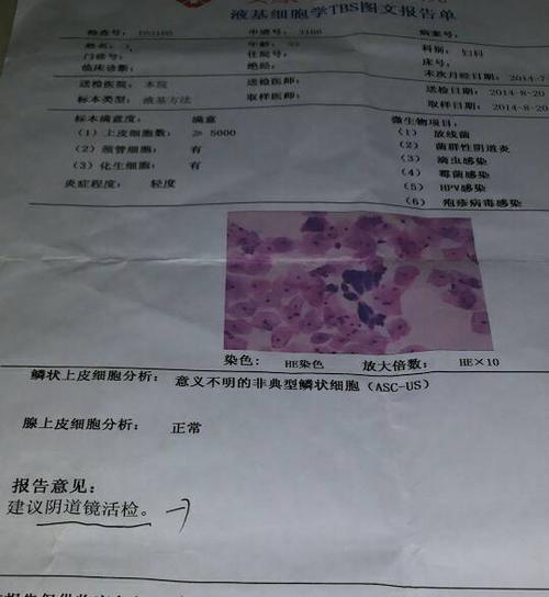 问:意义不明确的非典型鳞状细胞asc-us