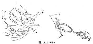 因此,目前已很少应用,多为剖宫产取代 (2)牵引产钳:因胎头位置高,牵引