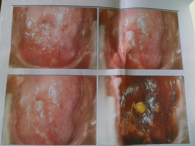 宫颈口红色区域为糜烂面