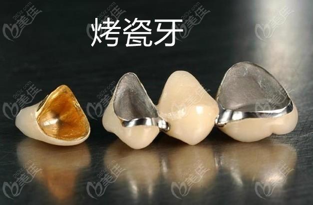 ——2000元起/颗这种烤瓷牙是百姓们常用的一种修复方式,内含金属材质
