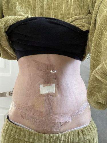 腹壁整形第七天,肚脐重塑 抽脂 修复直腹肌_疤痕_吸脂