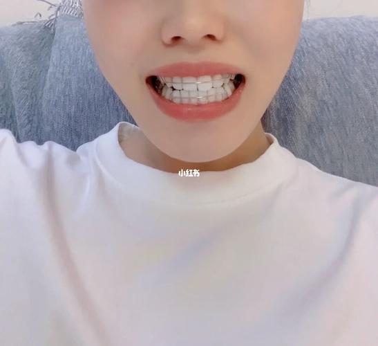 哈雷vs透明保持器到底哪个好?_保持器_牙套_牙医_磨牙