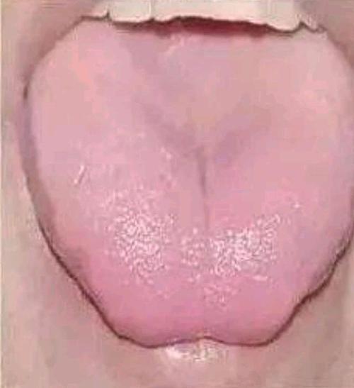 舌红少苔为阴虚内热. 绛舌,舌头的颜色比红舌更深,主热入营