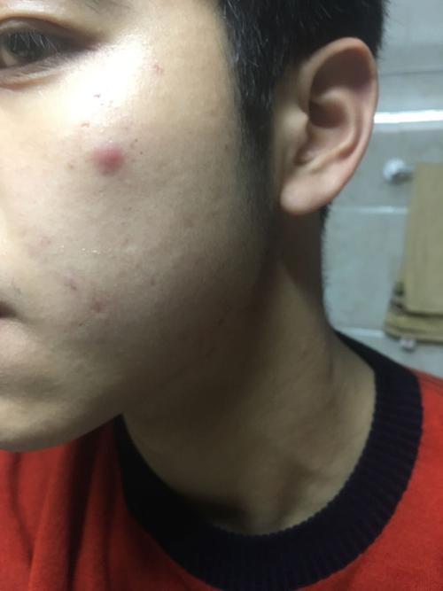 请问脸上长这个(不像是青春痘)类似疮的东西是什么.