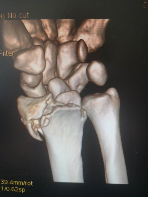 查体:左腕肿胀,畸形明显,腕关节压痛明显,可及骨擦感,左腕关节活动