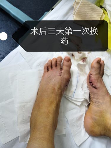 终于做了拇外翻手术_重庆攻略_医疗健康_医疗健康其他