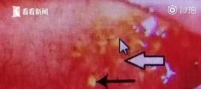 邵教授指出:"我们通常说的眼结石,指的是睑结膜结石.