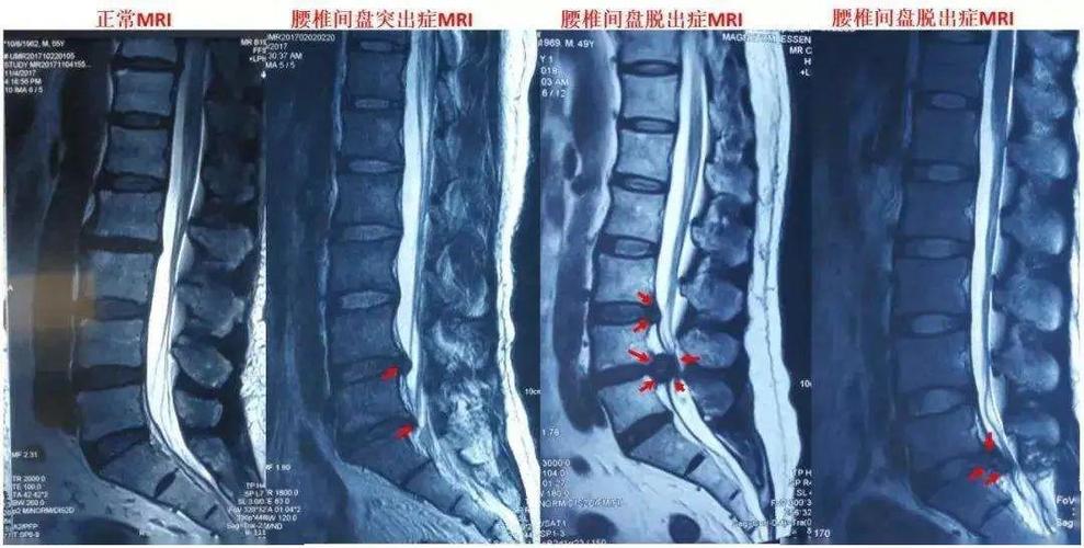腰椎间盘突出症和腰肌劳损你还傻傻分不清楚吗