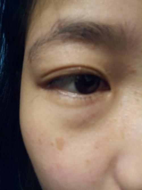 皮肤起这种鼓起来的黄斑,不痛不痒,可是在脸上很难看.