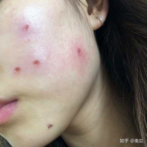 我的手术77激光祛痣恢复过程记录