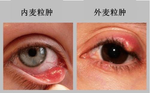 长个麦粒肿而已,竟引发了一场惨案!_眼皮