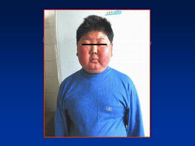 库欣综合征的症状有哪些