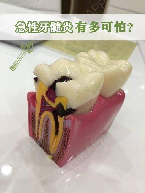 痛不知何起因为那是急性牙髓炎