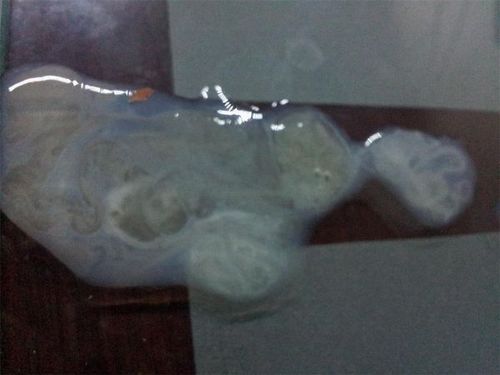 这样的精子正常吗?医生