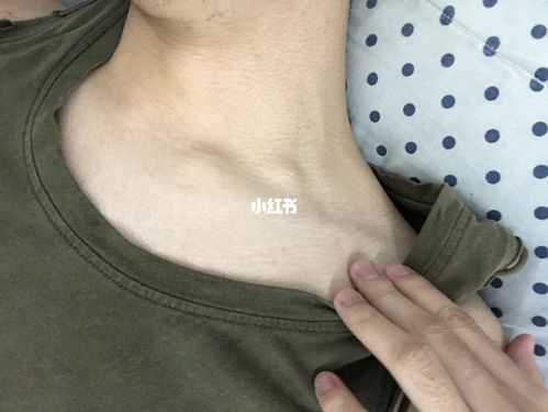 左锁骨上淋巴结肿大_淋巴结肿大_医疗健康_医疗健康