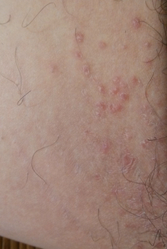 大腿湿疹症状大全