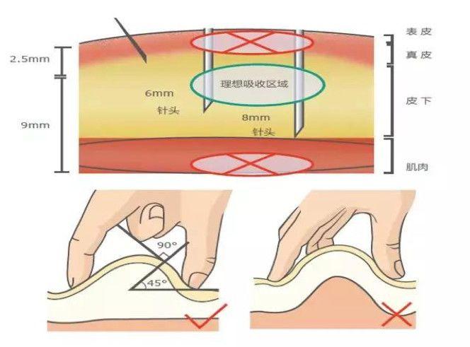 胰岛素的规范注射_部位