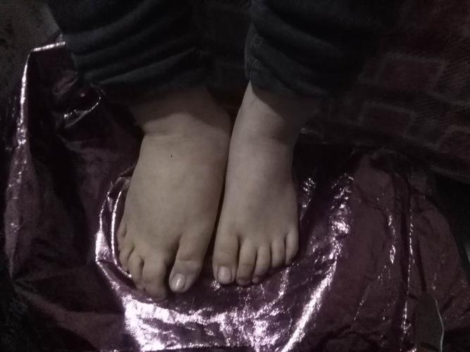 天生一个脚大一个脚小这是什么病现在10岁了男孩能治疗