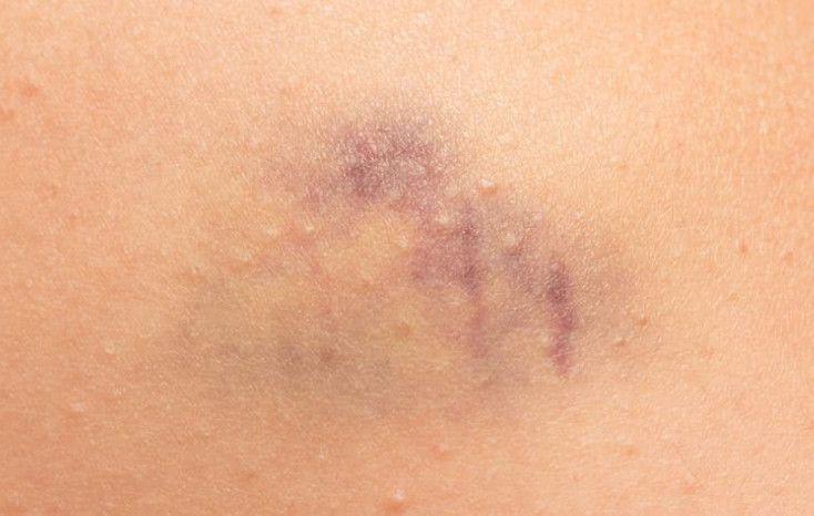 儿童患白血病,身体出现4个常见信号,早发现早治疗!