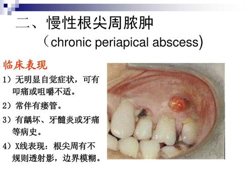 根尖周炎ppt