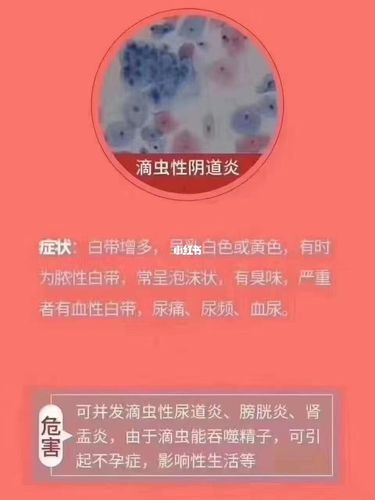 滴虫性y道炎 症状如下↘_私密护理_女性私密护理_医疗