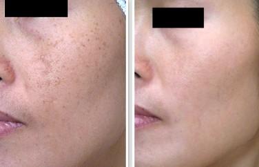 郑州拂斑堂雀斑形成的原因是什么